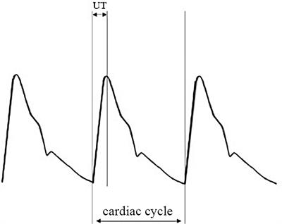 Evaluation of the role of combining inter-arm systolic pressure difference and derivatives of pulse volume recording in detecting subclavian artery stenosis